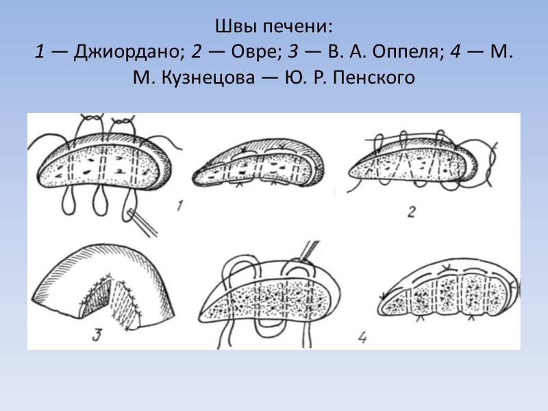 Швы печени: 1 — Джиордано; 2 — Овре; 3 — В. А. Оппеля; 4